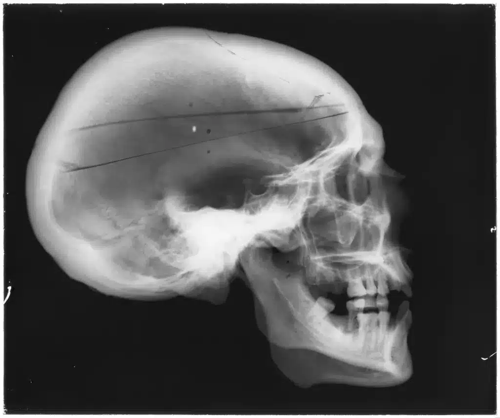 File:X-ray of a human skull, England, 1901-1930 Wellcome L0059386.jpg - a black and white photo of a